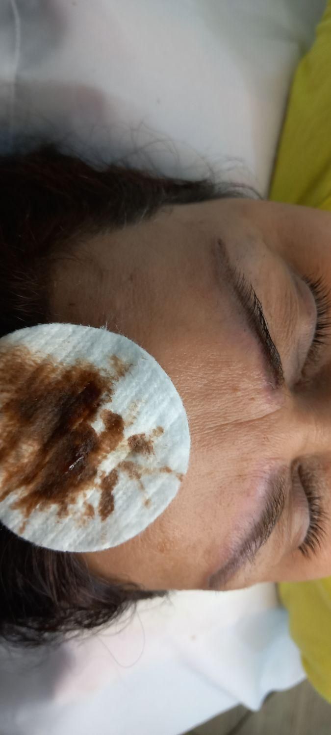 پاک کردن تتوهای قدیمی|خدمات آرایشگری و زیبایی|لنگرود, |دیوار