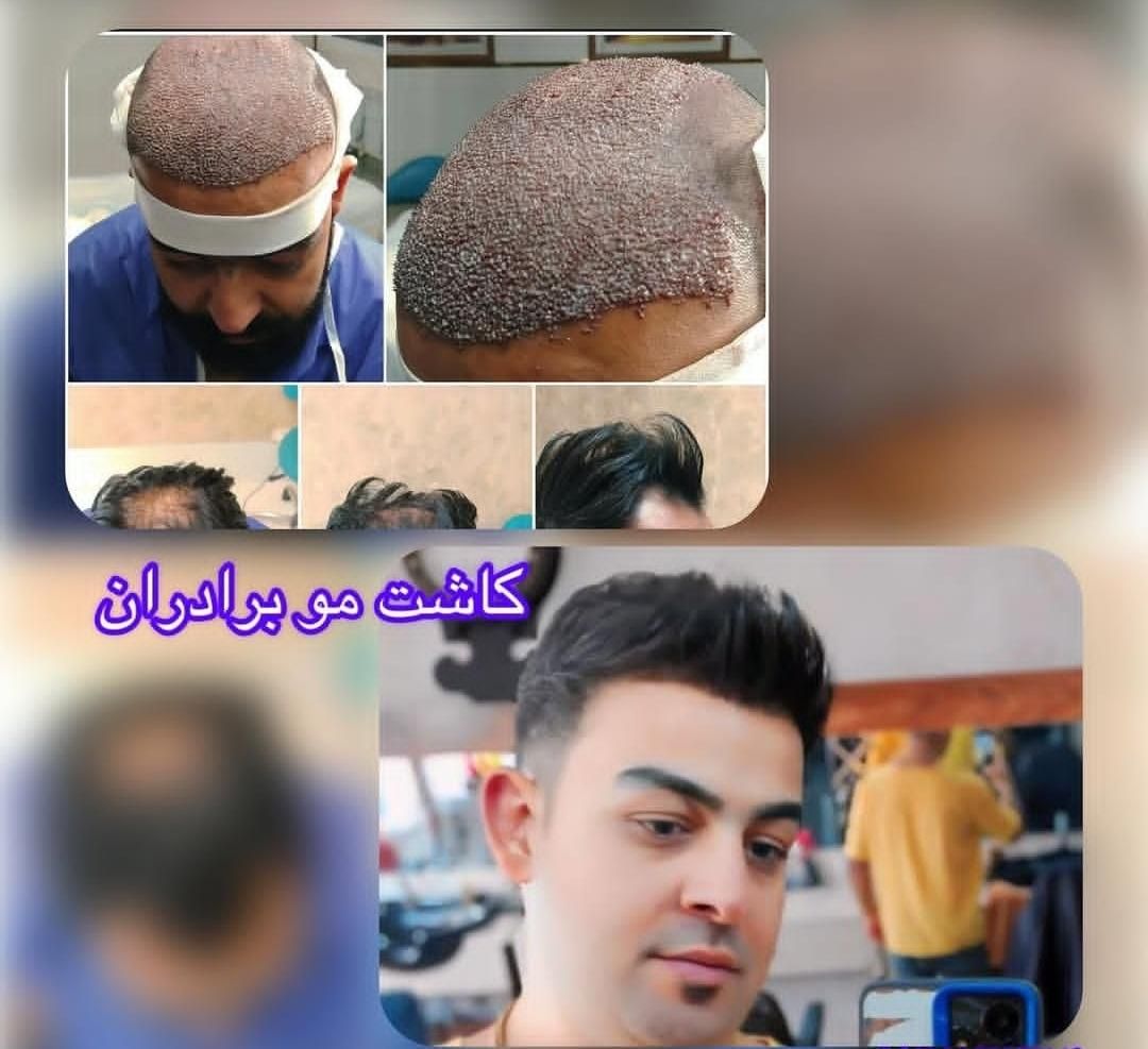کاشت مو و ابرو در تبریز، پیش پرداخت ۶میلیون|خدمات آرایشگری و زیبایی|اردبیل, |دیوار