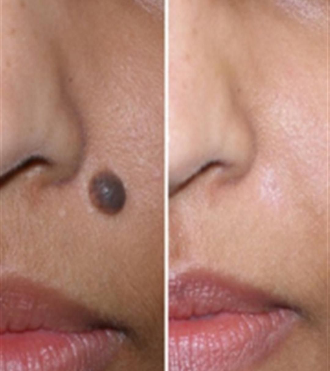 خال برداری و ضایعات پوستی در کلینیک معتبر|خدمات آرایشگری و زیبایی|کرمانشاه, |دیوار