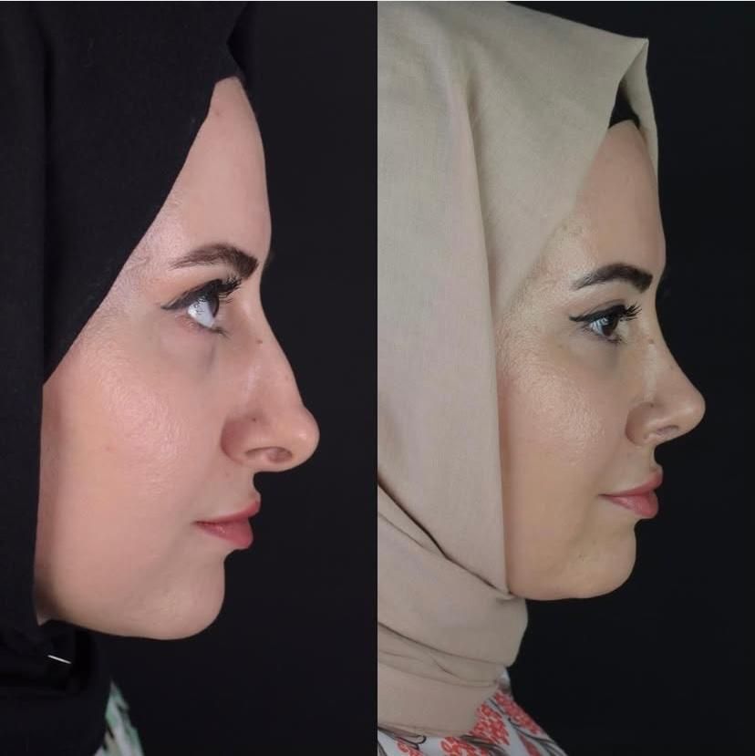 جراحی بینی پیکرتراشی برزیلی لیپو پروتز لیفت سینه|خدمات آرایشگری و زیبایی|تهران, تهرانپارس غربی|دیوار