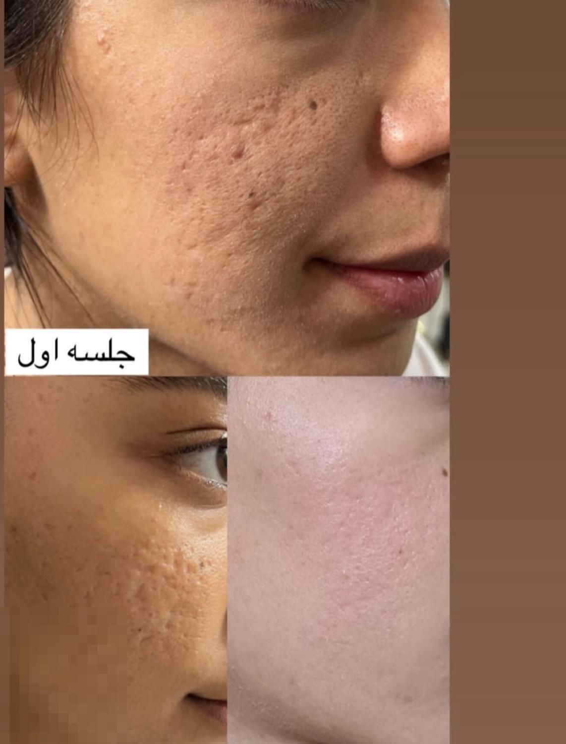 فیشیال تخصصی و درمانی فقط تا۹شهریور تخفیف داره|خدمات آرایشگری و زیبایی|مشهد, هنرستان|دیوار
