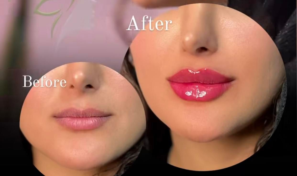 تزریق ژل و بوتاکس|خدمات آرایشگری و زیبایی|تهران, عبدل‌آباد|دیوار