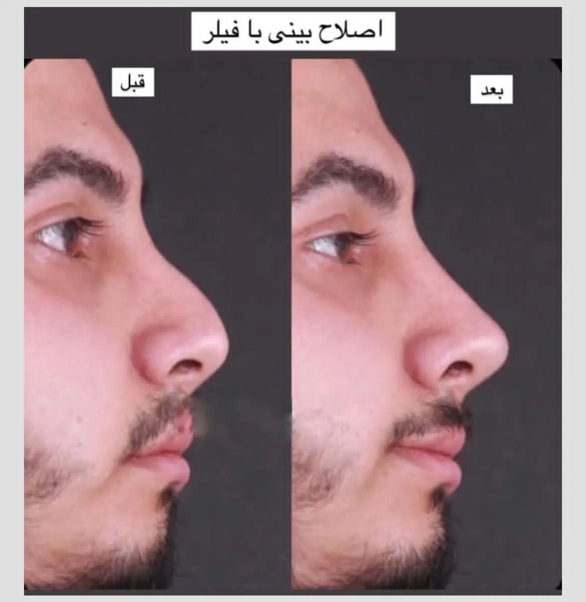 تزریق فیلر بادی کانتورینگ صورت بوتاکس ژل لب|خدمات آرایشگری و زیبایی|تهران, جردن|دیوار