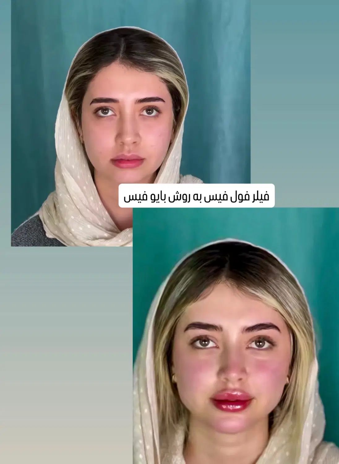 فیلر زل بوتاکس مزو بایو فیس لیفت پر کننده50/|خدمات آرایشگری و زیبایی|مشهد, هفت تیر (حافظ)|دیوار