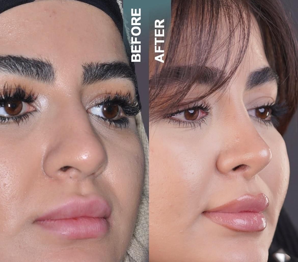 کامپوزیت لمینت ایمپلنت جراحی بینی بلفارو ساکشن|خدمات آرایشگری و زیبایی|مشهد, سجاد شهر|دیوار