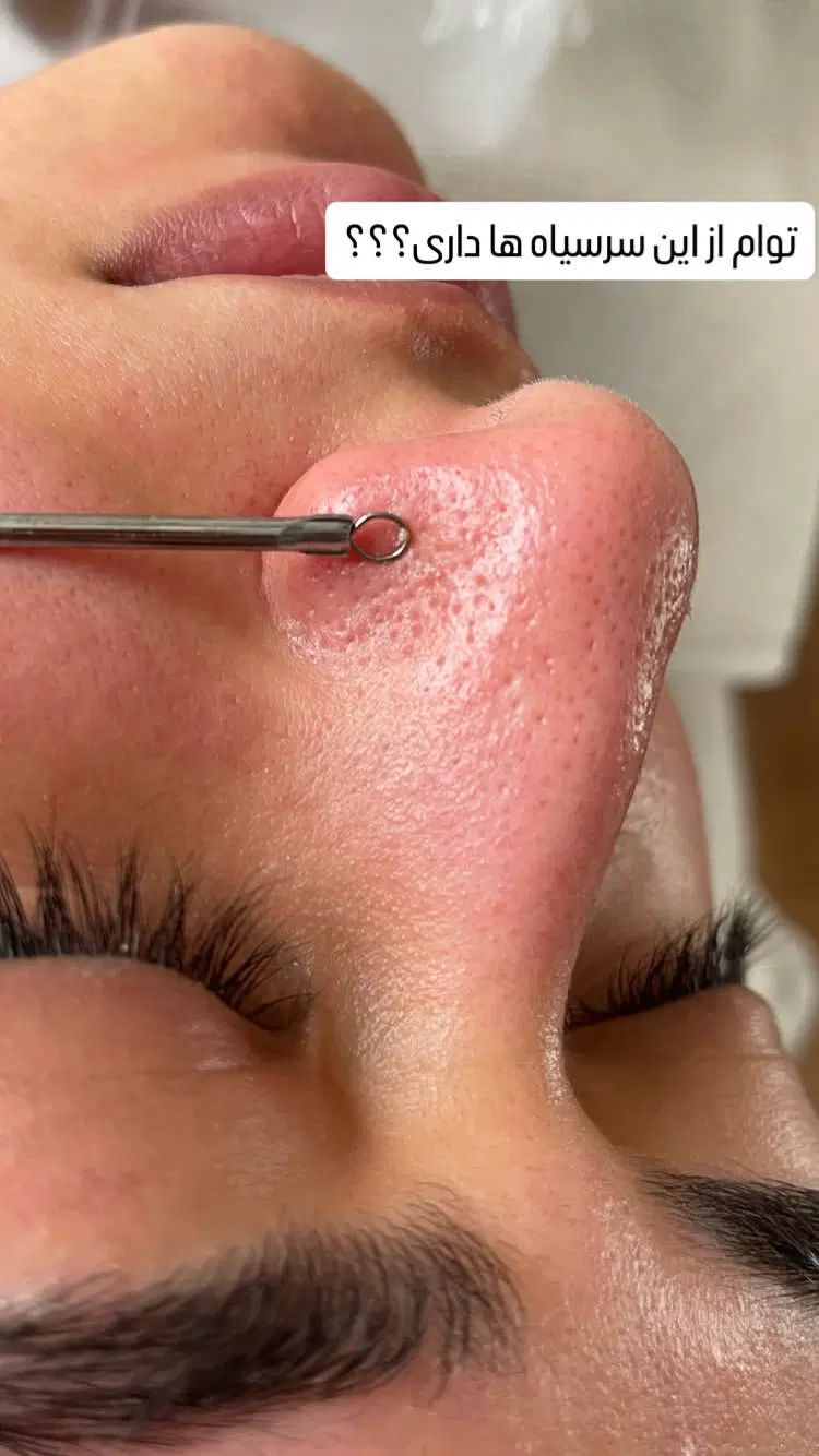 مدل جهت پاکسازی و فیشال و اسکراب اسکالپ پوست و مو|خدمات آرایشگری و زیبایی|مشهد, بهشت|دیوار