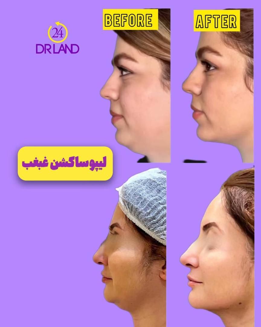 عمل لیپو شکم پهلو غبغب ابدو ماموپلاستی پروتز اقساط|خدمات آرایشگری و زیبایی|شیراز, زرگری|دیوار