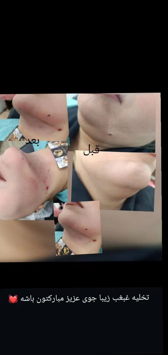 تزریق تخصصی ژل لب تزریق بادی لیفت نخ و چربی|خدمات آرایشگری و زیبایی|خرمشهر, |دیوار