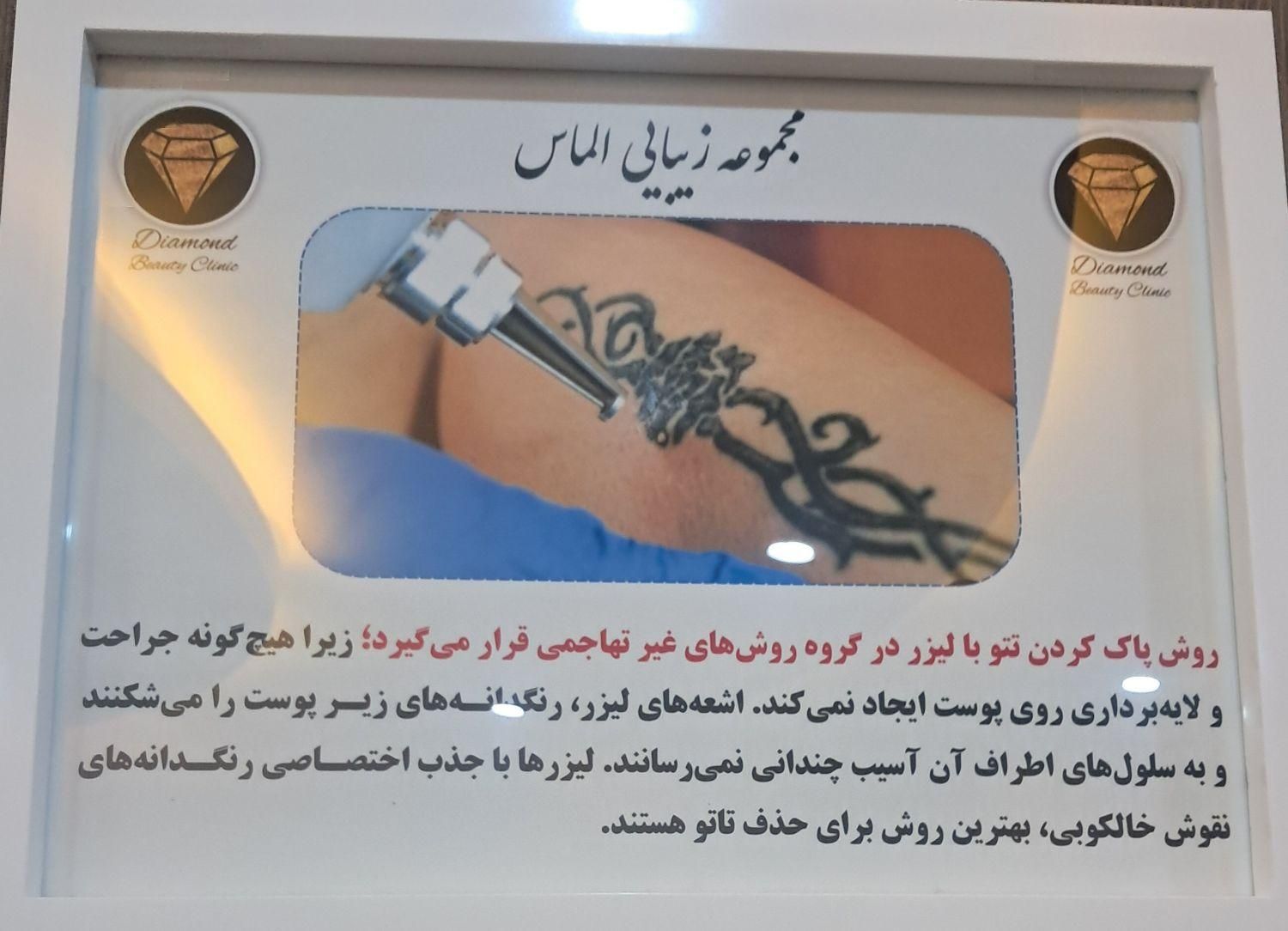 حذف انواع تتو توسط لیزر در کلینیک زیبایی الماس|خدمات آرایشگری و زیبایی|کرج, مهرویلا جنوبی|دیوار