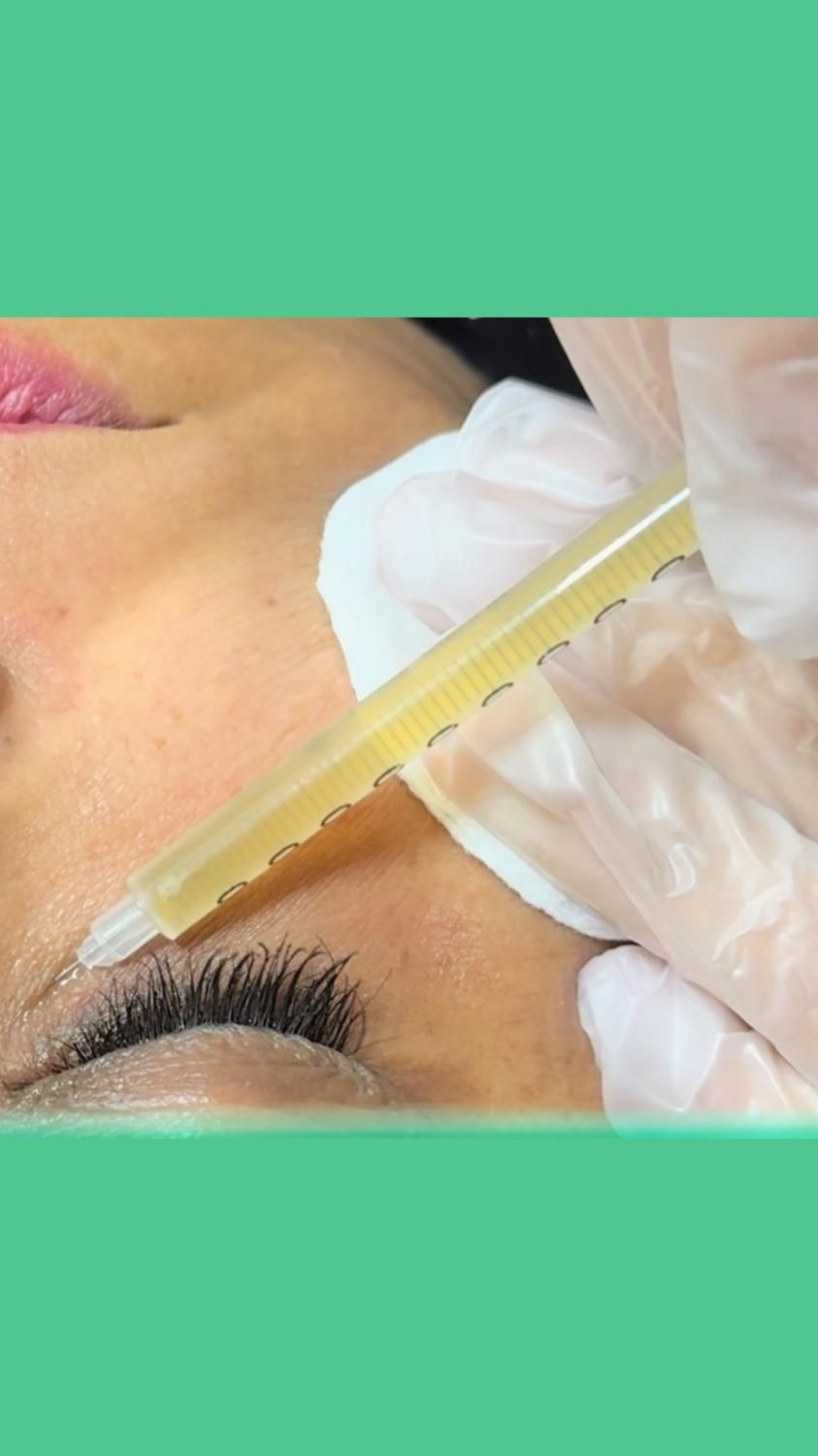 لیزر ژل بوتاکس توسط پزشک|خدمات آرایشگری و زیبایی|شاهین‌شهر, فردوسی|دیوار