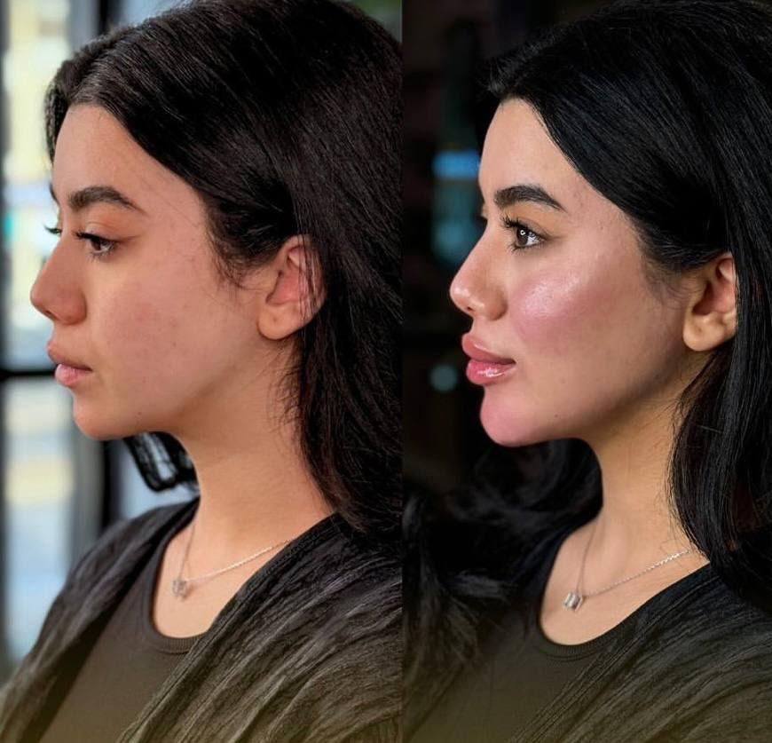 ژل لب ،زاویه سازی،فیلر چانه ،فول فیس|خدمات آرایشگری و زیبایی|مشهد, سجاد شهر|دیوار