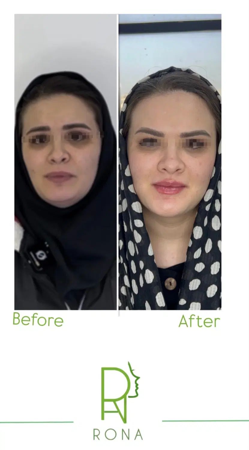 کانتورینگ فول فیس ، بوتاکس،لیزر ، ژل وفیلر ،فیشال|خدمات آرایشگری و زیبایی|فردیس, شهرک ۱۱۰|دیوار