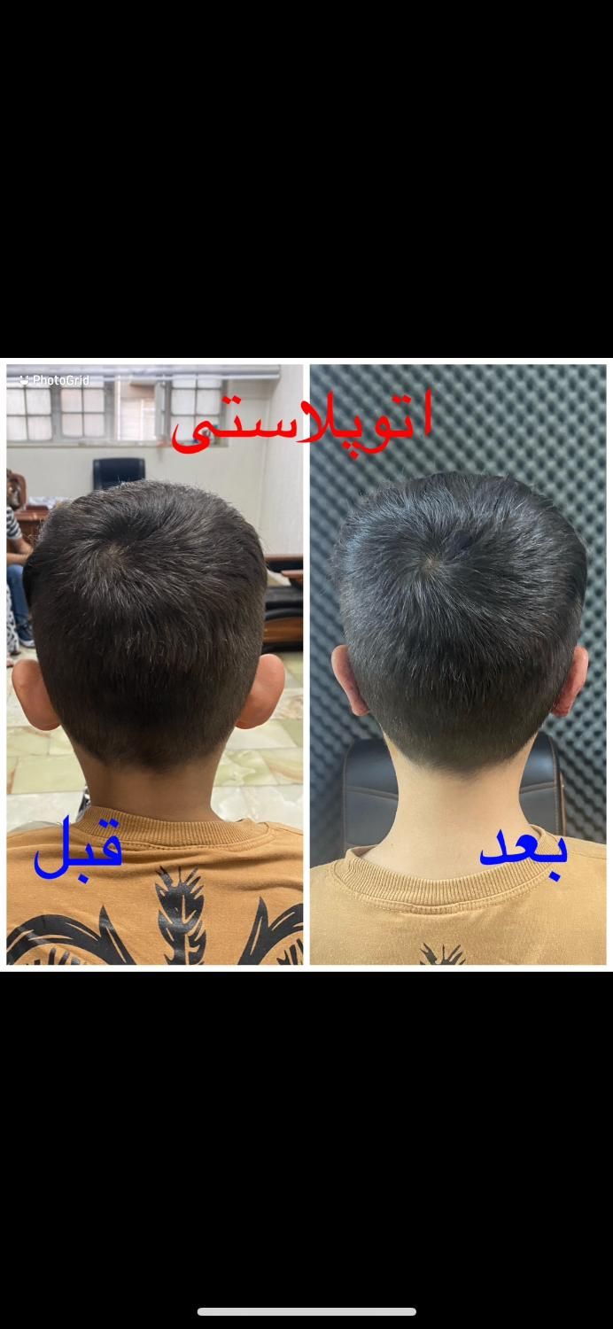 بلفاروپلاستی،لیفت صورت ابرو،اتوپلاستی،لیزر مو تاتو|خدمات آرایشگری و زیبایی|تبریز, |دیوار