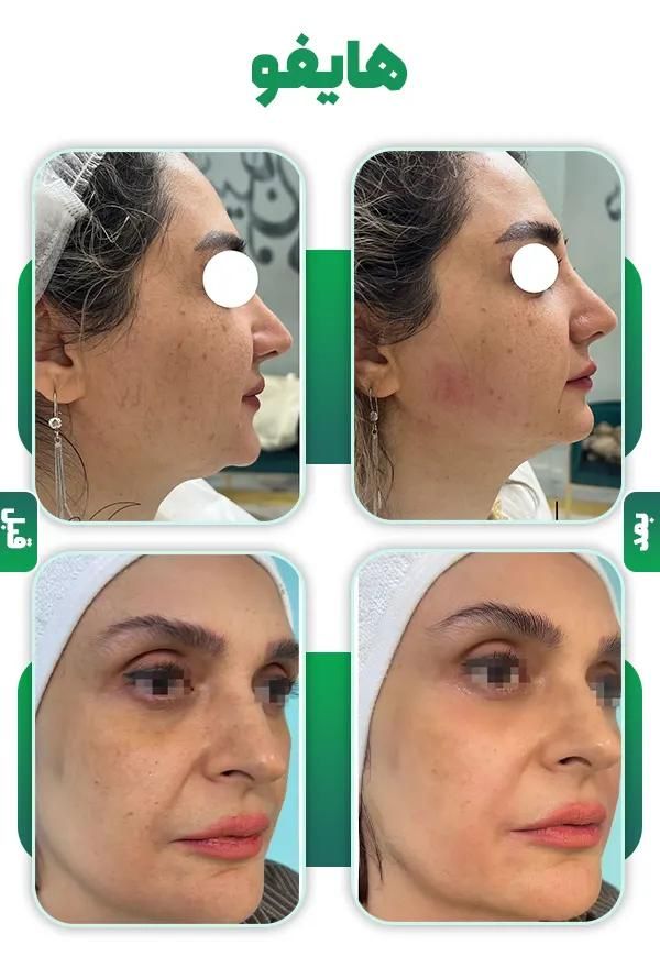 هایفو تراپی/پلاژن تراپی/کربوکسی/لیزربدن|خدمات آرایشگری و زیبایی|مشهد, محمدآباد|دیوار