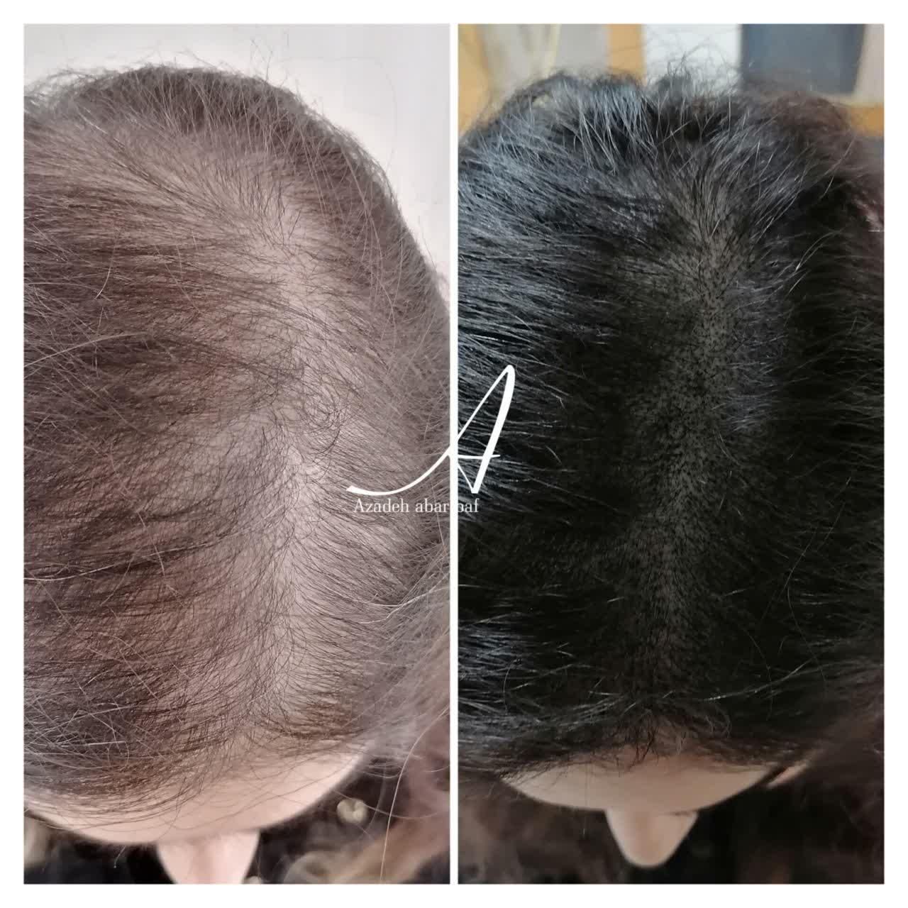 اسکالپ تخصصی در کلینیک پوست مو کاشت میکرو اسکالپ|خدمات آرایشگری و زیبایی|مشهد, شهید فرامرز عباسی|دیوار