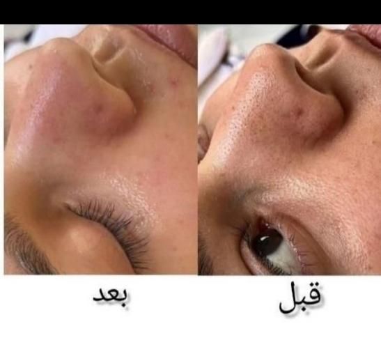 فشیال تخصصی با دستگاه و ماسک فقط ۴۰۰ تومان|خدمات آرایشگری و زیبایی|بهبهان, |دیوار