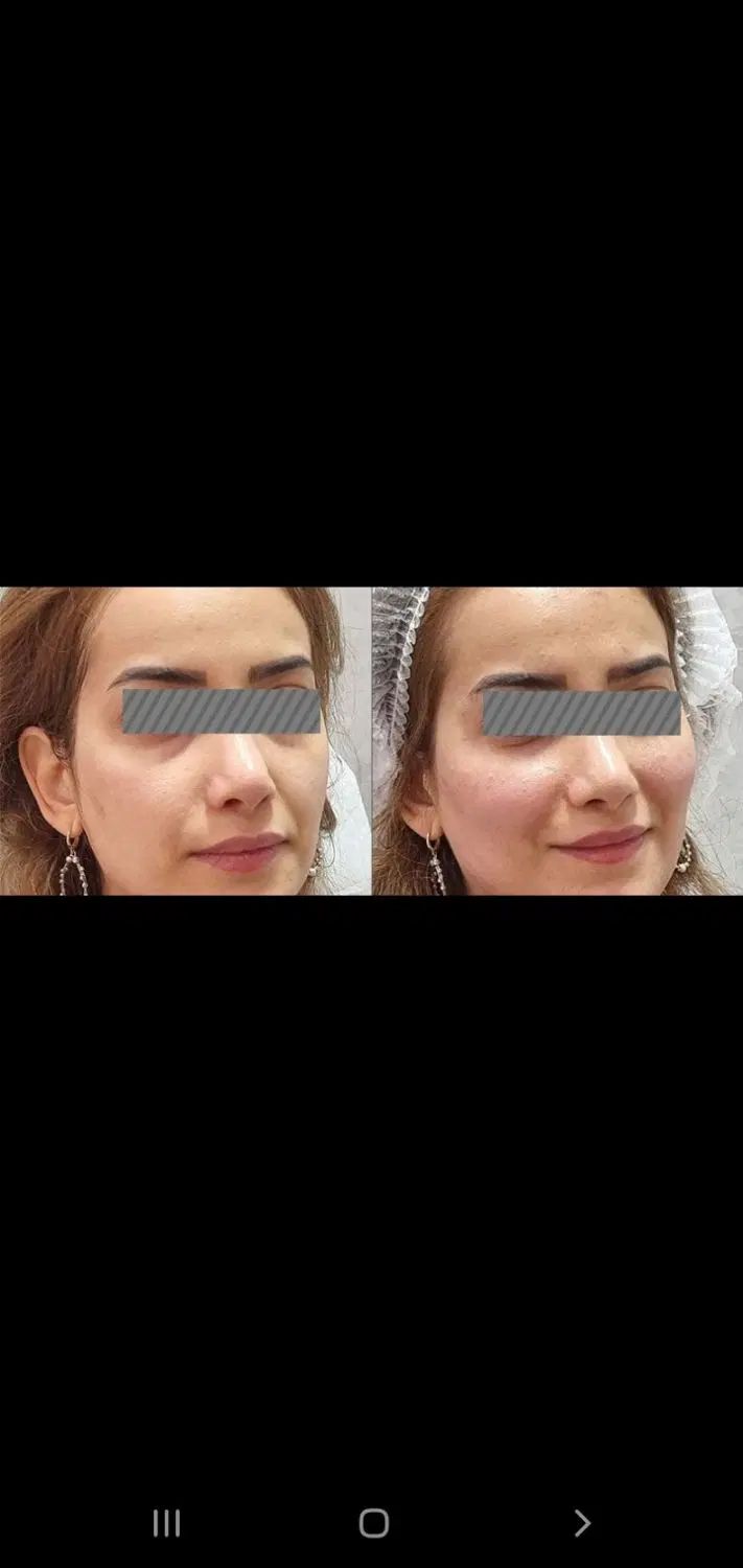 آف فیلرکانتورینگ(چانه گونه خط خنده خط غم زاویه فک)|خدمات آرایشگری و زیبایی|لاهیجان, طالقانی|دیوار
