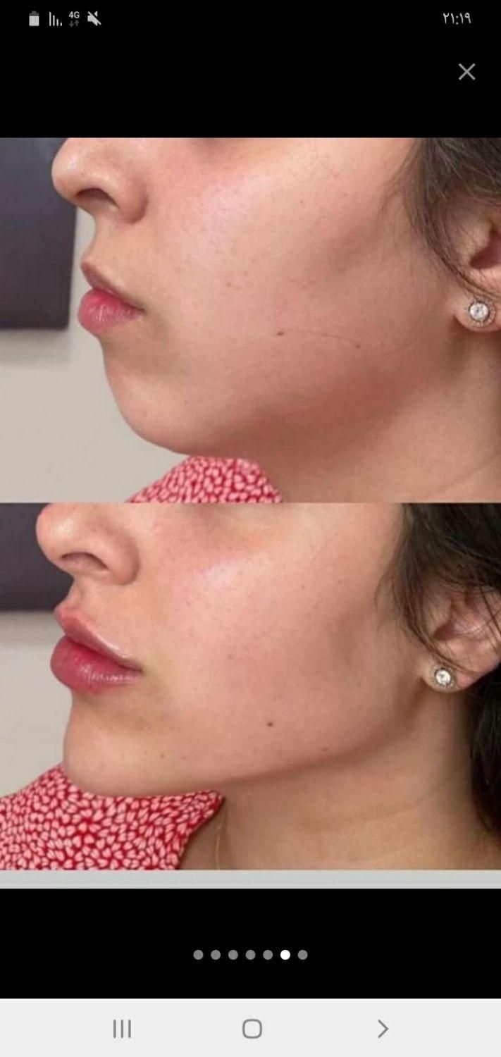 ژل .بوتاکس .هایفو.ساکشن غبغب وساکشن شکم وپهلو|خدمات آرایشگری و زیبایی|اصفهان, رکن الدوله غربی|دیوار