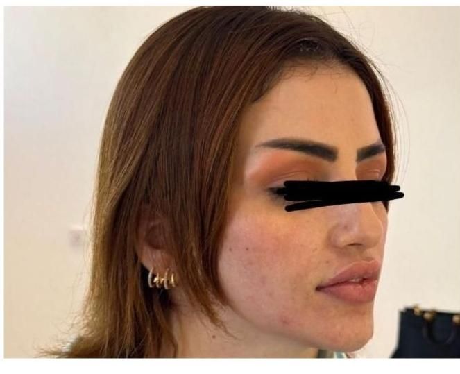 تزریق وآموزش ژل و بوتاکس چربی توسط دانشجویی پزشکی|خدمات آرایشگری و زیبایی|اهواز, زیتون کارمندی|دیوار