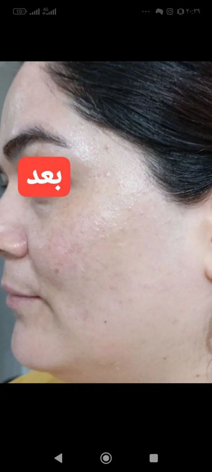 پاکسازی پوست با دستگاه هیدروفیشیال فقط 300|خدمات آرایشگری و زیبایی|مشهد, خواجه ربیع|دیوار
