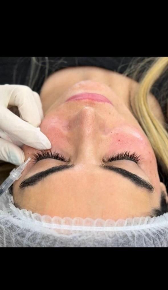 تزریق ژل بوتاکس مزوتراپی پاکسازی جوانسازی|خدمات آرایشگری و زیبایی|تهران, نیروی هوایی (پیروزی)|دیوار