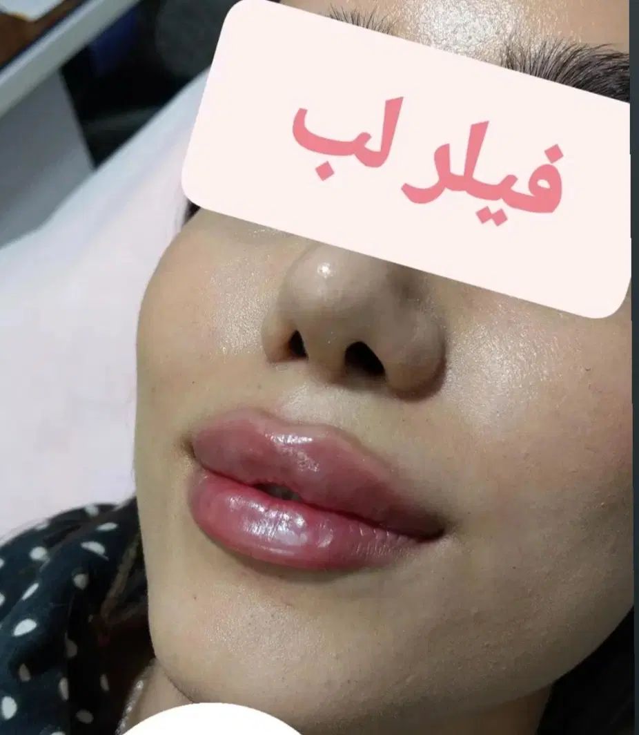 ژل و بوتاکس پی آرپی مزوتراپی|خدمات آرایشگری و زیبایی|تهران, کیانشهر|دیوار