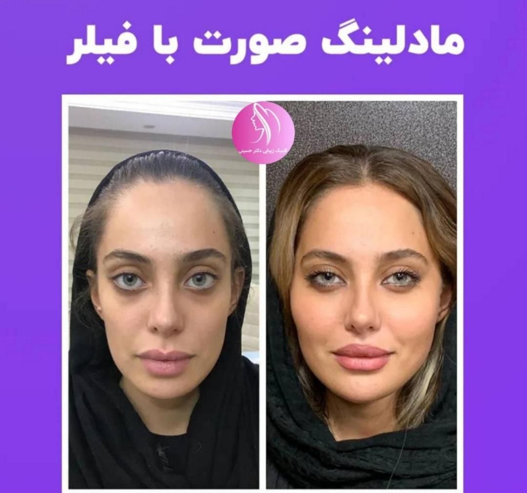 تخفیف تزریق ژل لب روسی لیفت صورت لیزرموهای زائدنخ|خدمات آرایشگری و زیبایی|تهران, صادقیه|دیوار