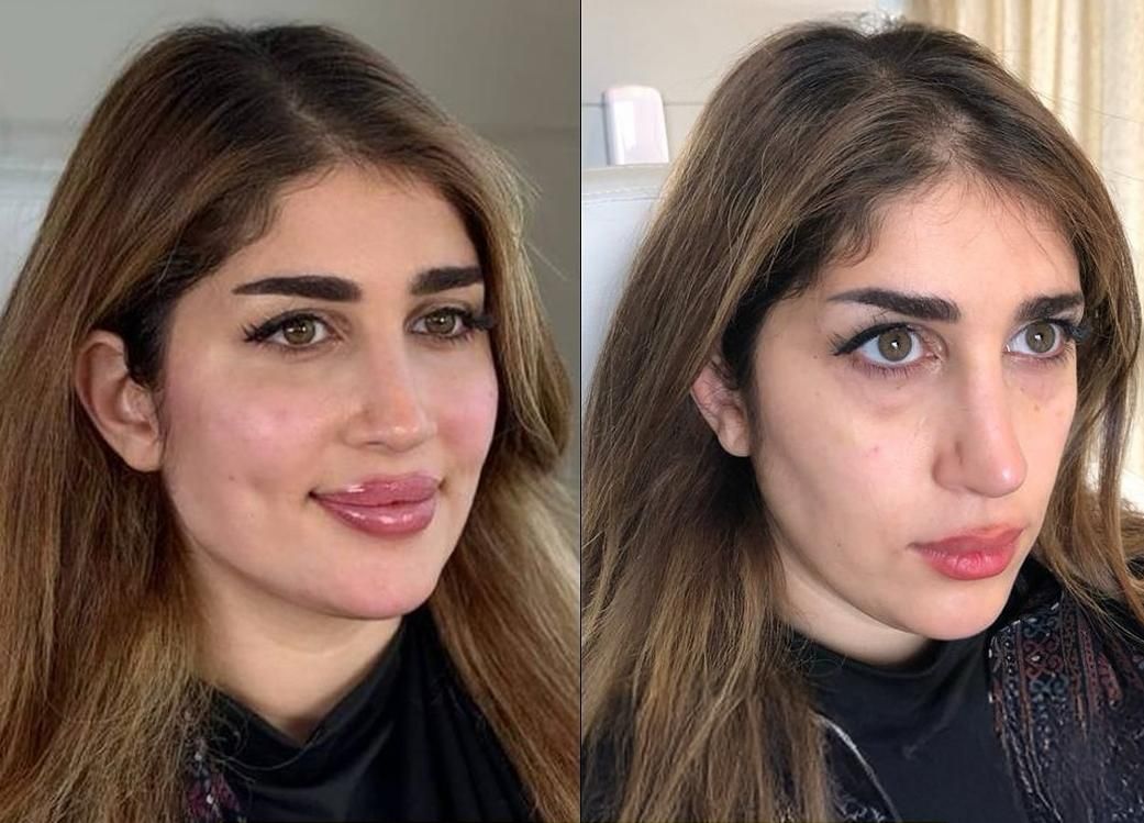 تزریق ژل و بوتاکس طراحی چهره برای زیبایی‌خاص|خدمات آرایشگری و زیبایی|تهران, شادمان|دیوار