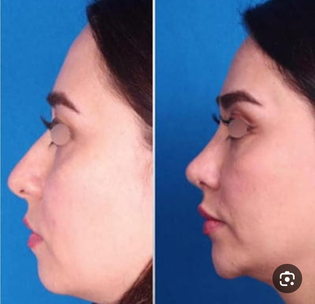 جراحی بینی بدون تامپون با ۲۵ سال سابقه|خدمات آرایشگری و زیبایی|کرج, مهرویلا جنوبی|دیوار