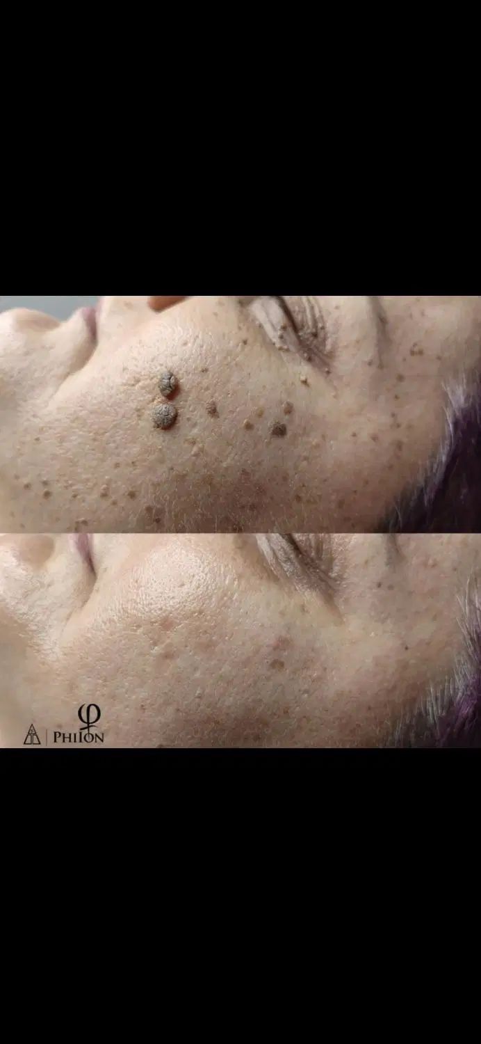 لیفت و جوانسازی پلک بدون جراحی با تخفیف ۵۰ درصد|خدمات آرایشگری و زیبایی|اصفهان, مرداویج|دیوار