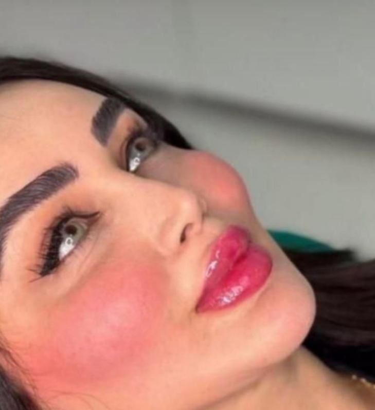 تزریق ژل فیلر لب،گونه،چانه،زاویه،بینی|خدمات آرایشگری و زیبایی|رشت, رشتیان|دیوار
