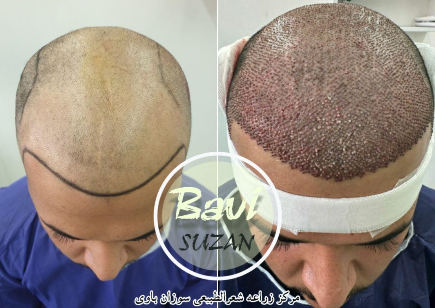 کاشت مو طبیعی سر و ابرو و ریش با ضمانت نامه کتبی|خدمات آرایشگری و زیبایی|اهواز, کیانپارس |دیوار