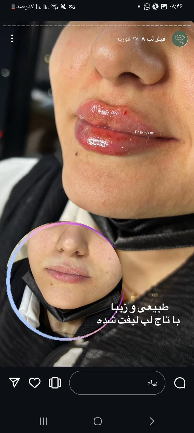 لیزر موهای زاید تزریق بوتاکس وژل  توسط پزشک|خدمات آرایشگری و زیبایی|تالش, هشتپر|دیوار