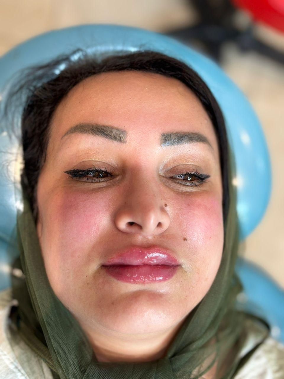 آموزش تزریق ژل به طور کامل|خدمات آموزشی|ساری, |دیوار