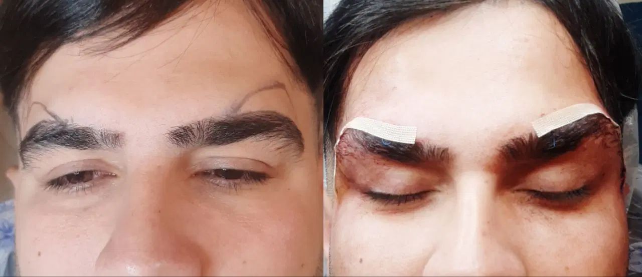 عمل لیفت ابرو وشقیقه جراحی ۸م بوتاکس مصپورت ۶۰۰|خدمات آرایشگری و زیبایی|مشهد, شهید فرامرز عباسی|دیوار