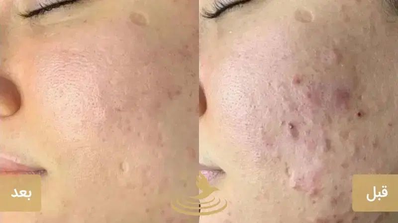 از بین بردن جای جوش و لک ،به روش مزونیدلینگ|خدمات آرایشگری و زیبایی|شیراز, معالی‌آباد|دیوار