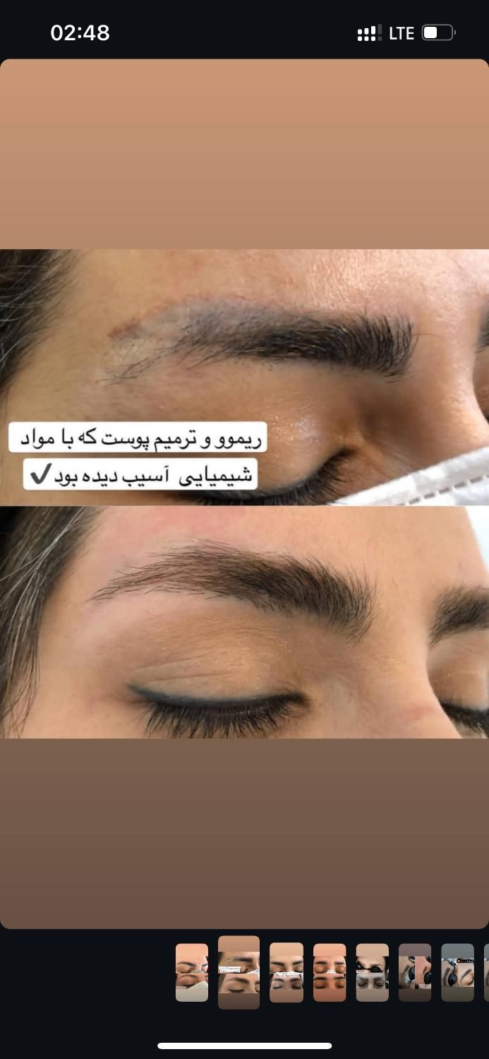ریموتتوروشن کردن نواحی تیره درمان لک|خدمات آرایشگری و زیبایی|قم, باجک دو|دیوار