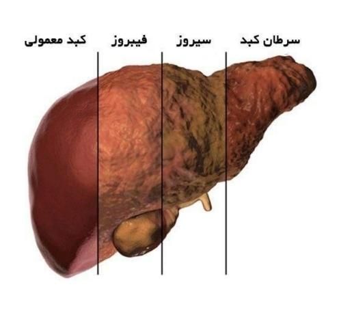 بهبود عملکرد کبد درمان قطعی|خدمات آرایشگری و زیبایی|اردبیل, |دیوار