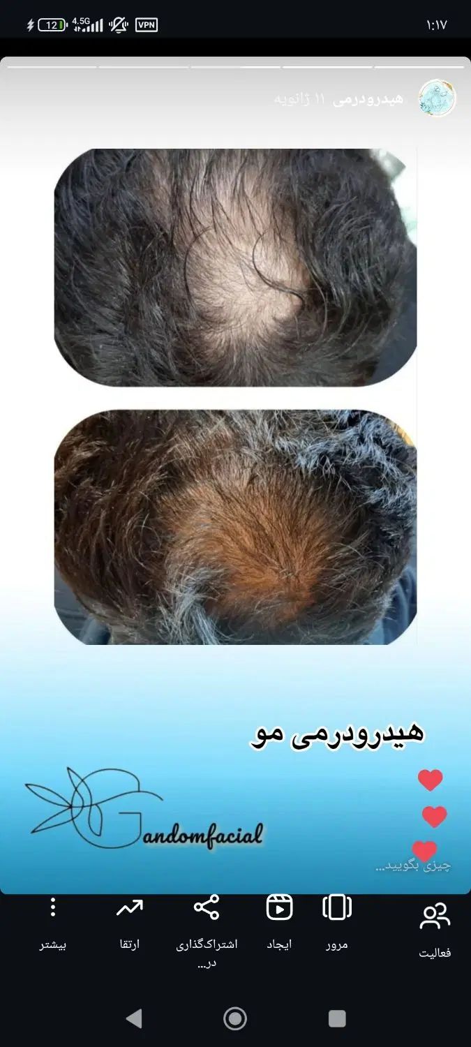 پاکسازی جوانسازی پوست و خالبرداری و مزو و بوتاکس|خدمات آرایشگری و زیبایی|سمنان, |دیوار