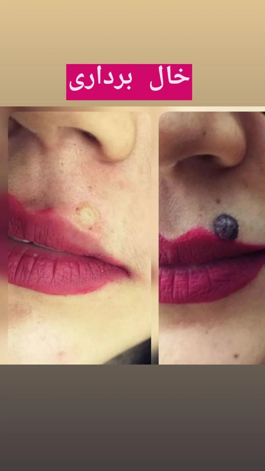 لیزر موهای زائد و الکترولیز|خدمات آرایشگری و زیبایی|فولادشهر, B5|دیوار