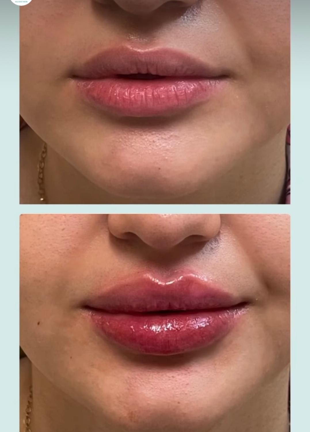 ژل فیلر بوتاکس جوانسازتوسط پزشک زیبایی در کلینیک|خدمات آرایشگری و زیبایی|مشهد, کوثر|دیوار