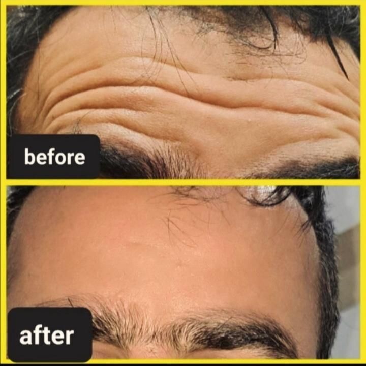 نیازمند مدل بوتاکس و ژل.اموزش ژل و بوتاکس|خدمات آرایشگری و زیبایی|صدرا-فارس, فاز ۱|دیوار