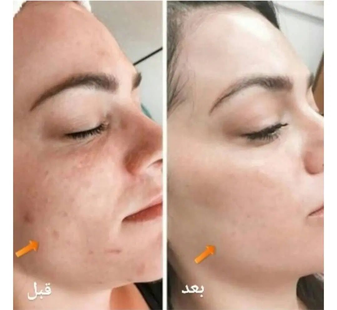 آموزش خدمات پی آرپی،مزوتراپی،بلکسر،فیشال،اسید|خدمات آرایشگری و زیبایی|کرج, گوهردشت|دیوار