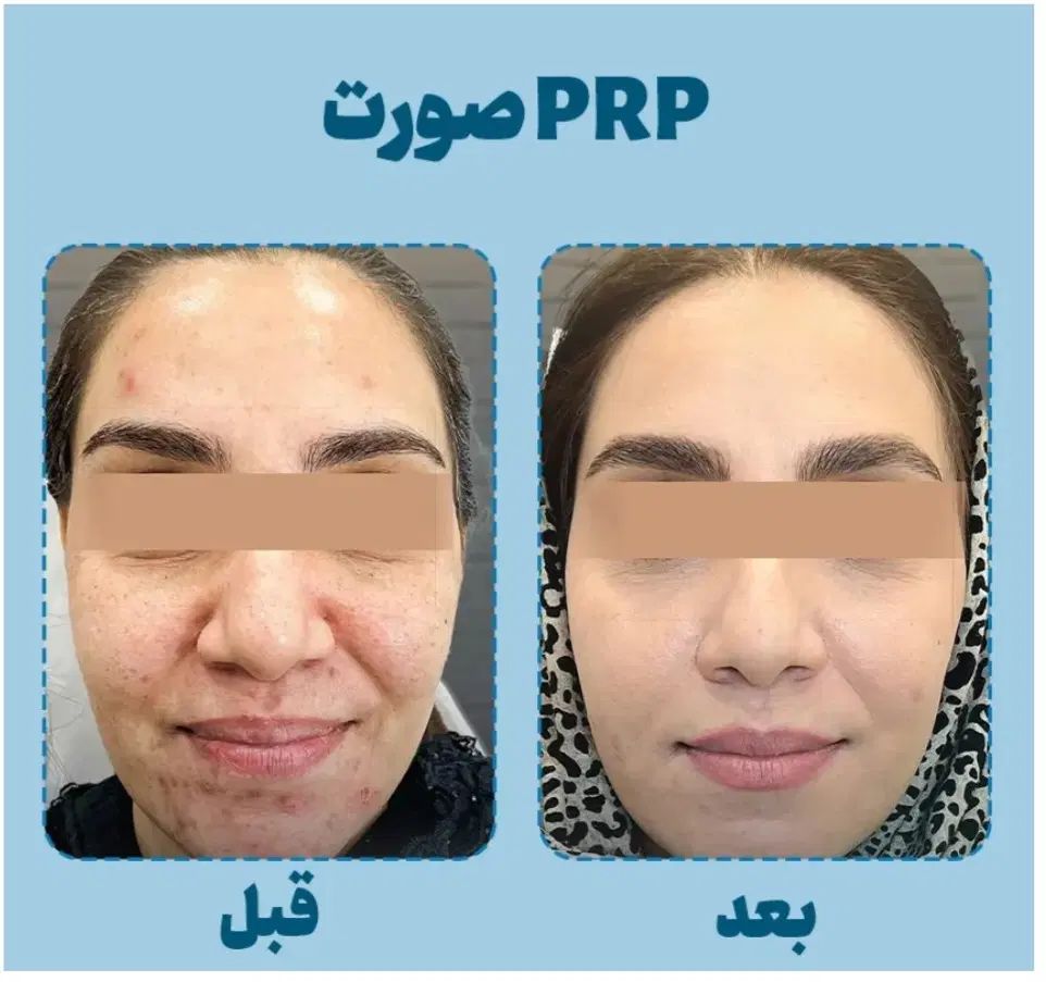 پی آر پی|خدمات آرایشگری و زیبایی|مشهد, کلاهدوز|دیوار