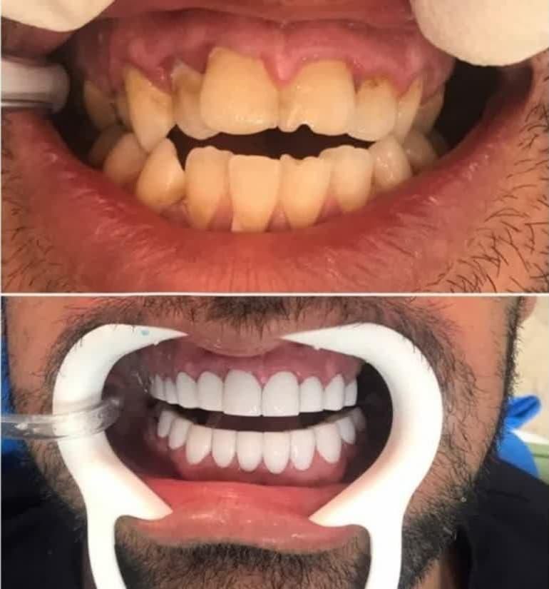 جشنواره دندان ونیر کامپوزیت روکش لمینیت عصب  IMAX|خدمات آرایشگری و زیبایی|تهران, هفت حوض|دیوار