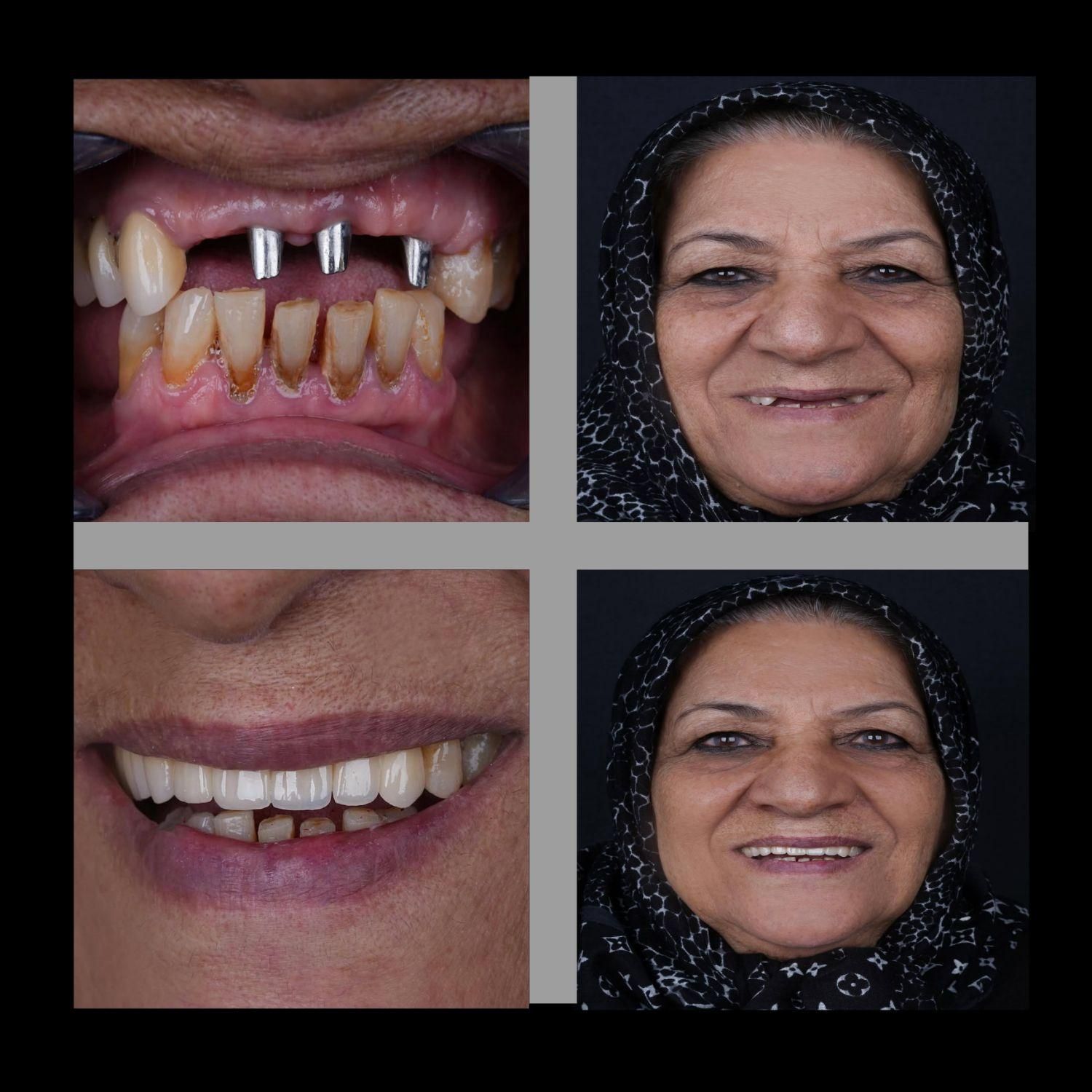 ایمپلنت دیجیتال/فوری/کاشت دندان/جراحی/دندانپزشکی|خدمات آرایشگری و زیبایی|تهران, سلسبیل شمالی|دیوار