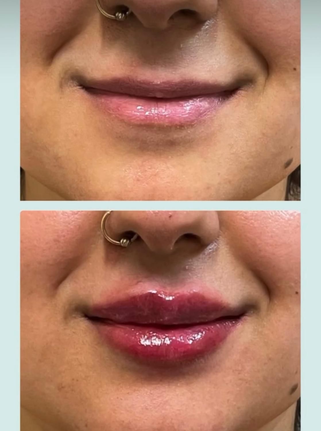 ژل فیلر بوتاکس جوانسازتوسط پزشک زیبایی در کلینیک|خدمات آرایشگری و زیبایی|مشهد, کوثر|دیوار