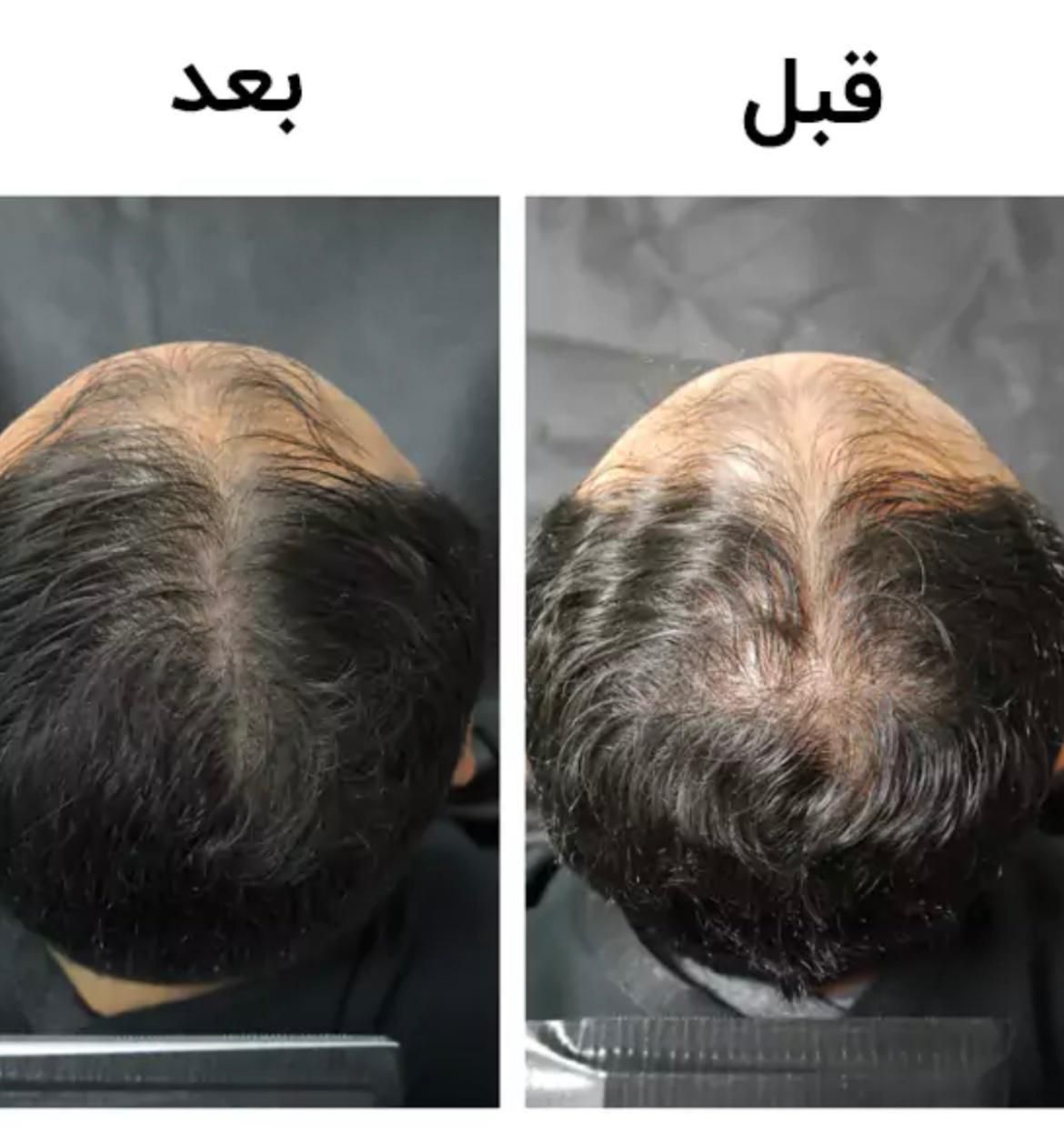 درمان قطعی ریزش مو|آرایشی، بهداشتی، درمانی|رشت, کوی جام جم|دیوار