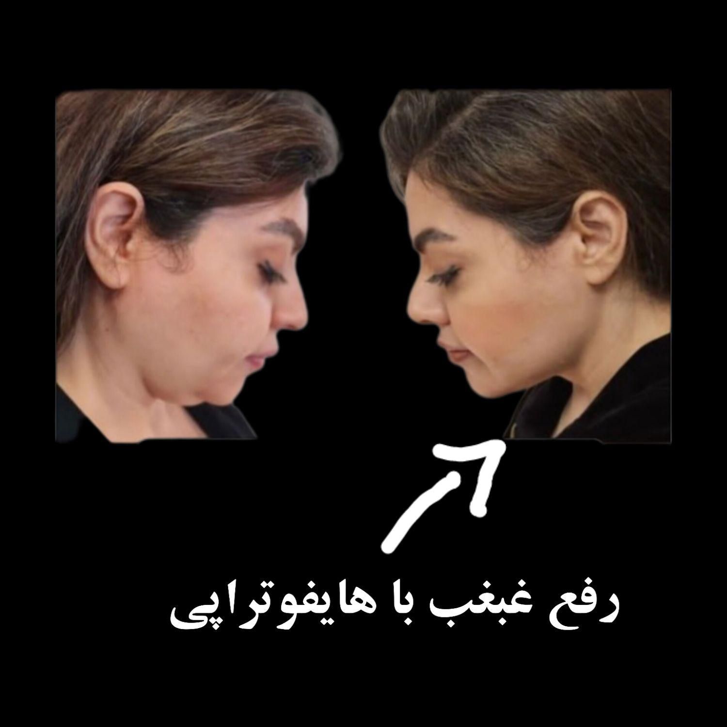 لیزر موهای زائد صورت وبدن،  جوانسازی پوست|خدمات آرایشگری و زیبایی|رفسنجان, |دیوار