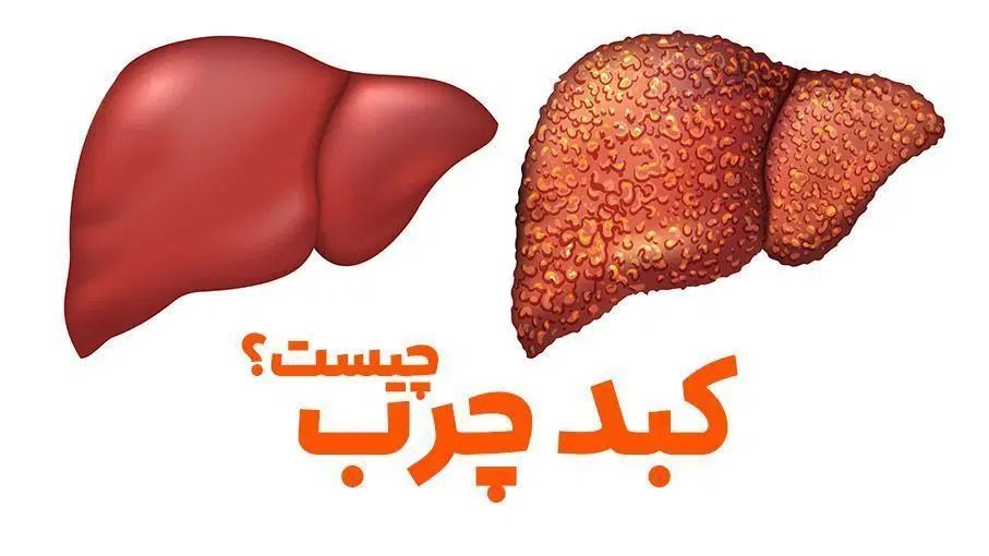درمان کبدچرب صدرصد*کاملا گیاهی و بدون عوارض*|آرایشی، بهداشتی، درمانی|اصفهان, شاهزاده ابراهیم|دیوار